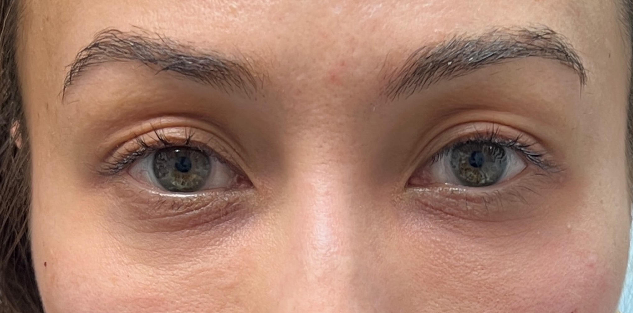 PRF BIO FILLER under eye